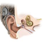 International Cochlear Implant Day