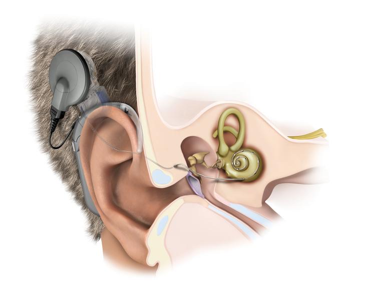 International Cochlear Implant Day